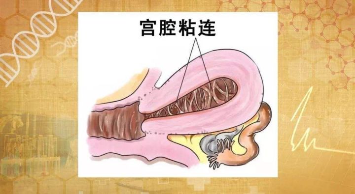有宫腹腔镜微创手术治愈输卵管迂曲粘连的姐妹吗_宫腔粘连_重度宮腔粘连图片