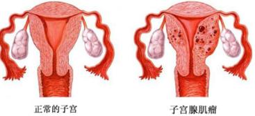 子宫腺肌病三大治疗方案!