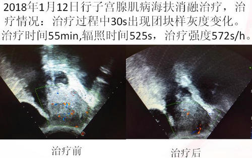 子宫腺肌症怎么治疗_子宫腺肌症_子宫腺肌症的症状