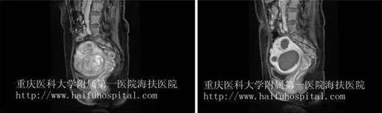 子宫腺肌病三大治疗方案!