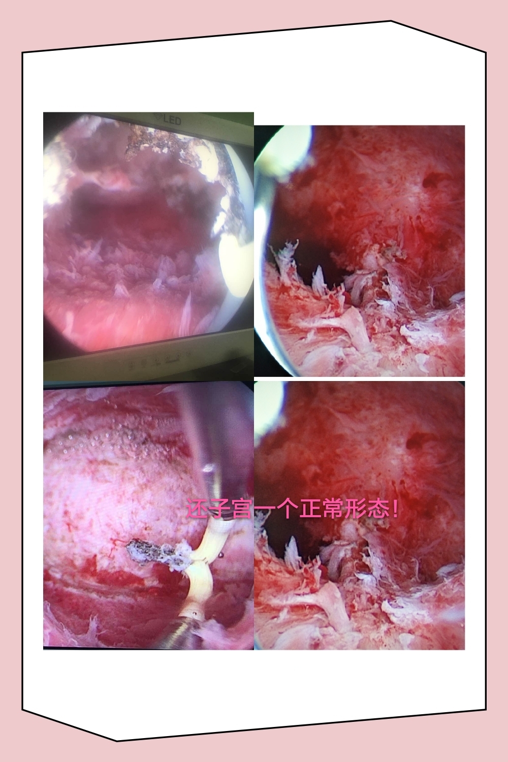 宫腔镜检查后_复兴医院宫腔镜检查_宫腔镜检查