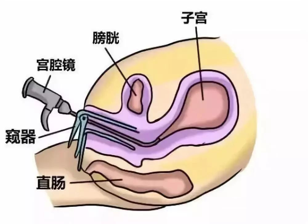 宫腔镜检查_复兴医院宫腔镜检查_宫腔镜检查后