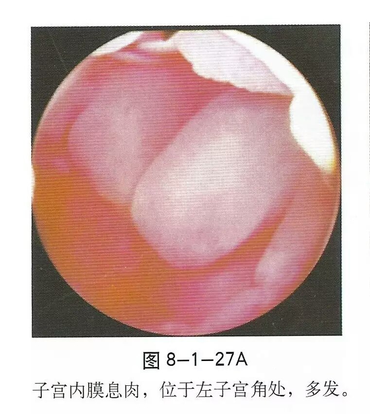 宫腔镜检查