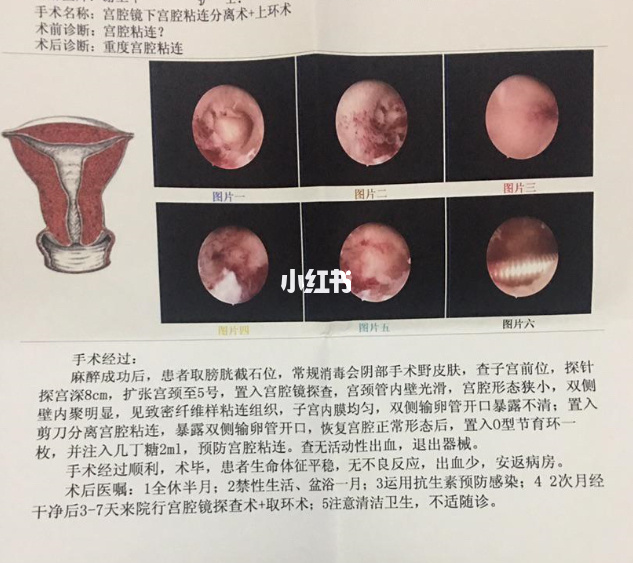 宫腔镜检查_什么情况做宫腔镜检查_宫腔镜检查