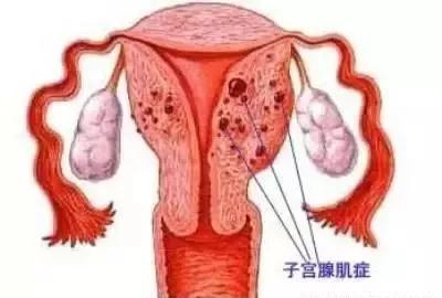 子宫腺肌症的治疗_子宫腺肌症_子宫腺肌症的症状