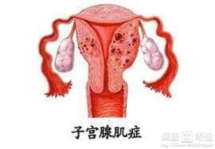 子宫腺肌症的症状_子宫腺肌症_子宫腺肌症的治疗
