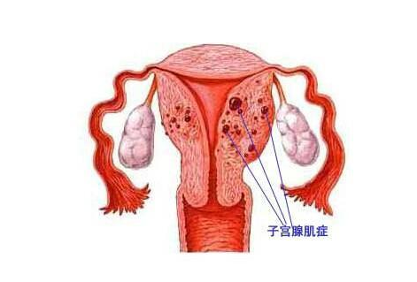 子宫腺肌症的治疗_子宫腺肌症_子宫腺肌症的症状