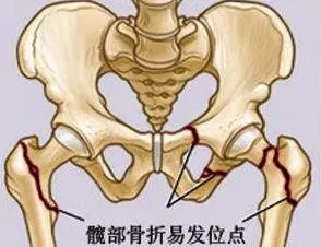 激素引起的低钾怎么办_人促黄体生成激素低_雌激素低怎么办