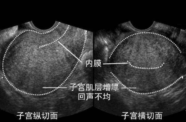 正常子宫宫内膜厚度_排卵内膜正常厚度是多少_子宫内膜厚度