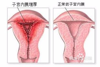内膜厚度多少正常受孕吗_子宫内膜厚度_子宫双层内膜厚度多少正常