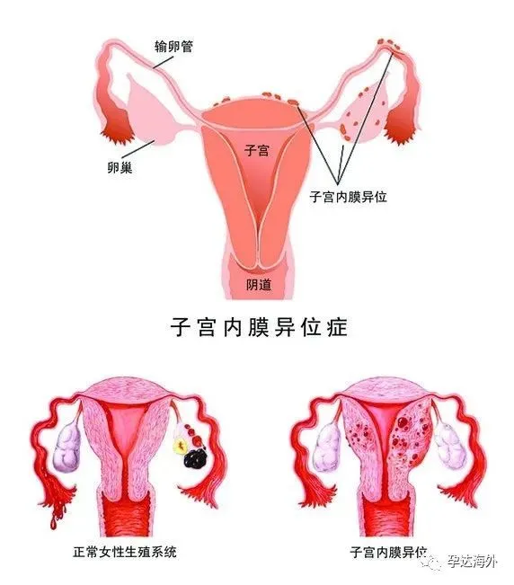 子宫内膜厚度_子宫双层内膜厚度多少正常_内膜厚度多少正常受孕吗