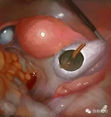巧克力囊肿_囊肿巧克力 囊肿_巧克力 囊肿