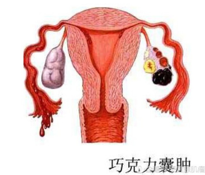 囊肿巧克力 囊肿_巧克力囊肿_巧克力 囊肿