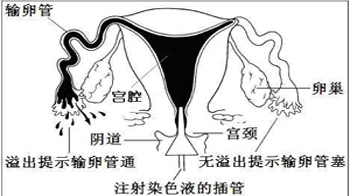 输卵管b超造影和x造影_造影可以疏通输卵管吗_输卵管造影