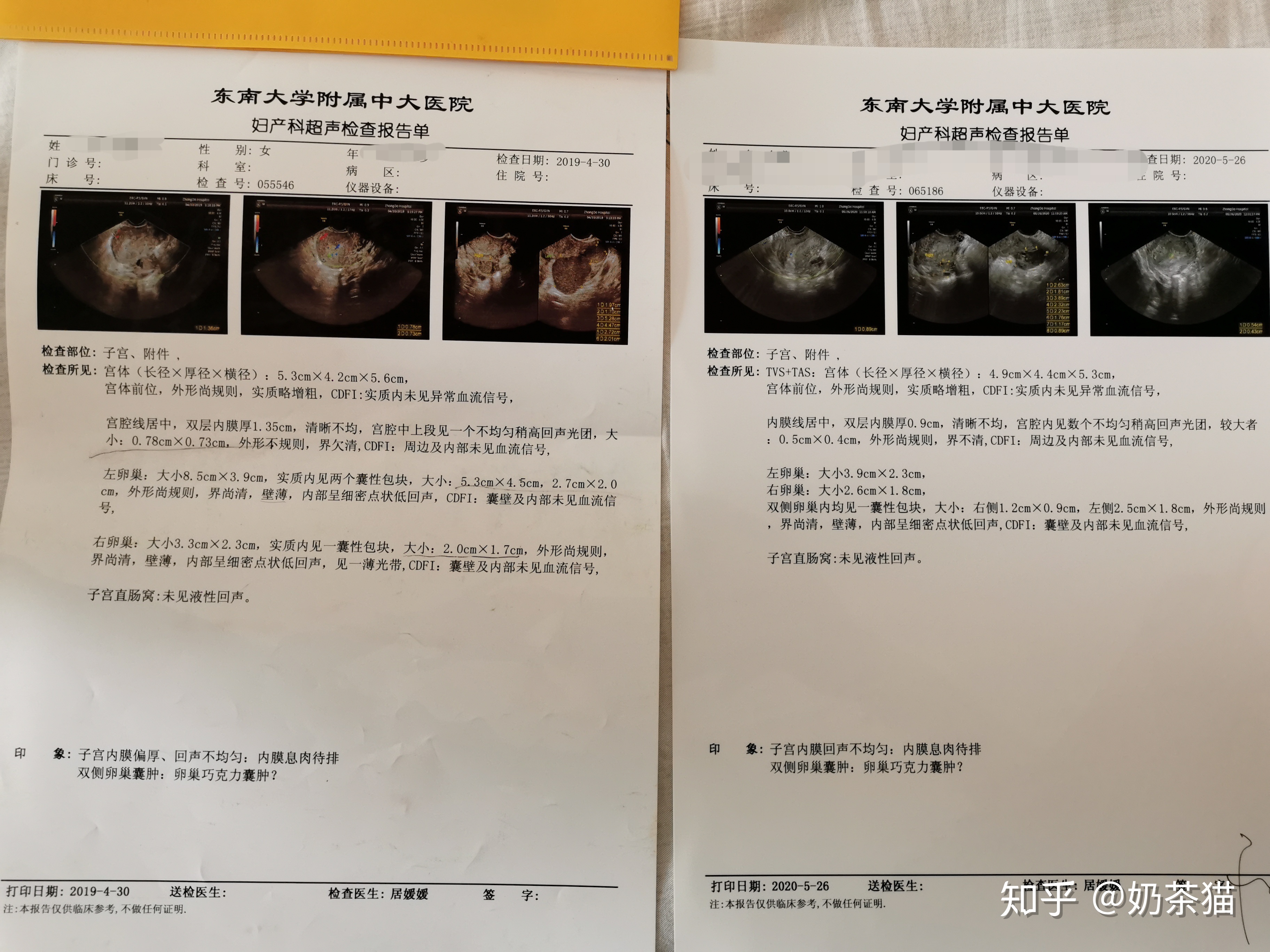 巧克力囊肿