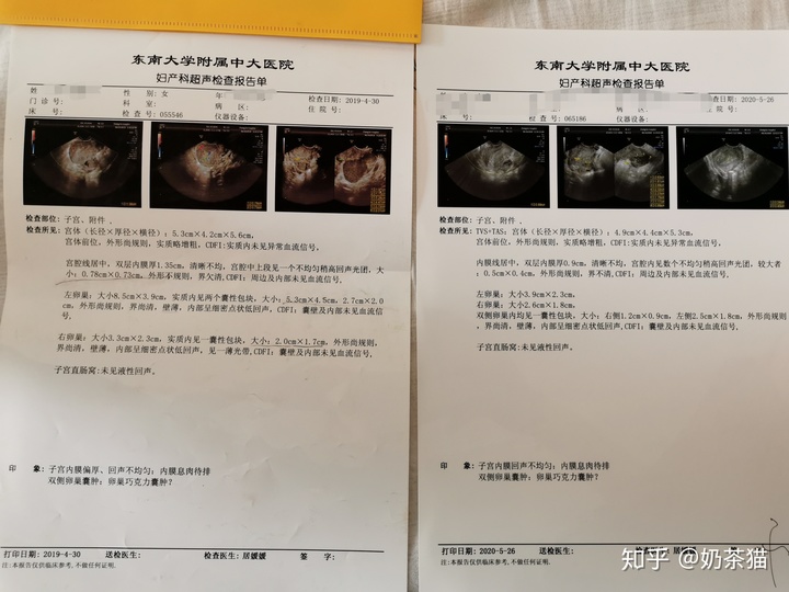 巧克力囊肿