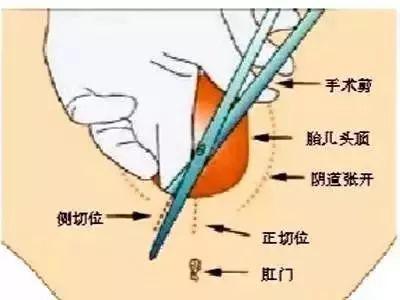 侧切_顺产 侧切_侧切伤口图片
