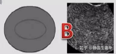 子宫内膜薄