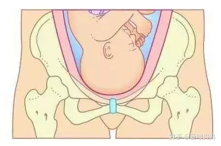 盆底肌修复