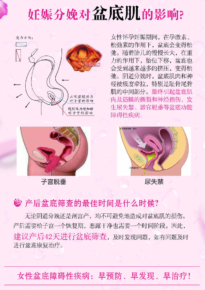 盆底肌修复_医院盆底肌修复怎么做_盆底肌康复治疗