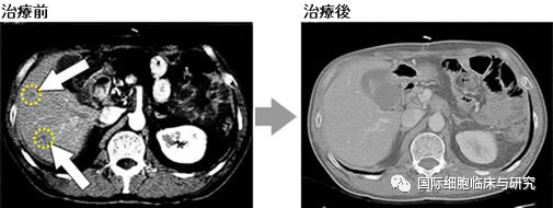NK细胞治疗胰腺癌前后对比