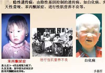 特纳氏综合症_特纳氏综合症_特纳氏综合症 病因