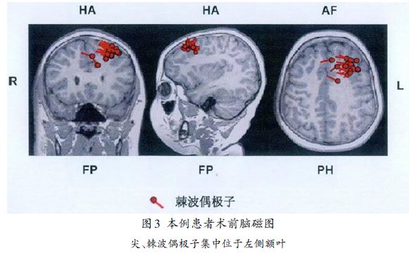 马凡氏综合症_柯兴氏综合症是特别胖吗_法乐氏三联症