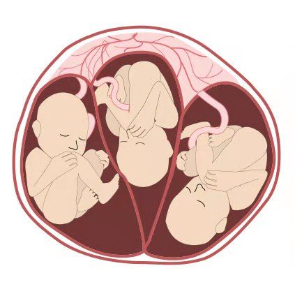 多胎妊娠_足月妊娠正常胎心音_多胎妊娠减胎术