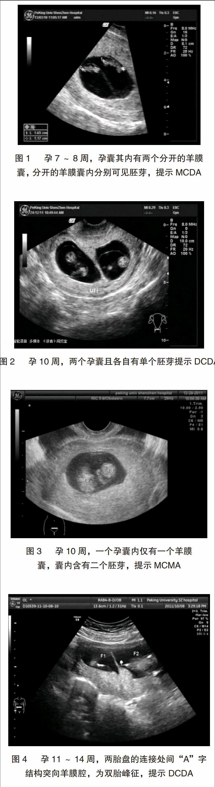 多胎妊娠减胎术_多胎妊娠_足月妊娠正常胎心音
