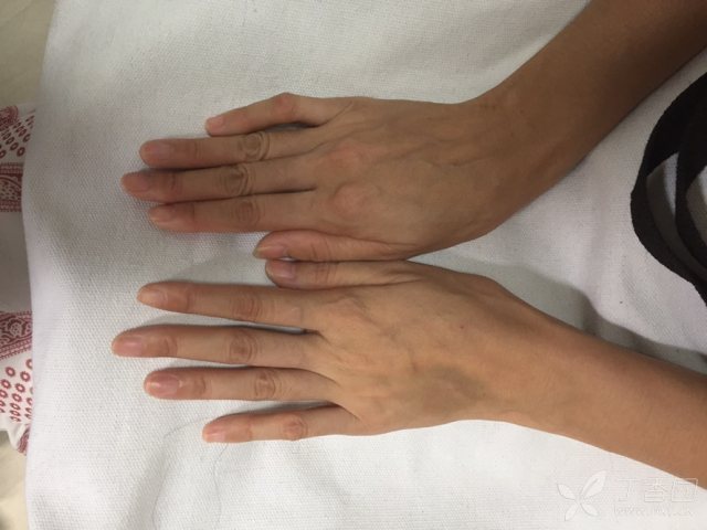 马凡氏综合症