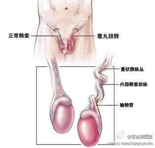睾丸扭转