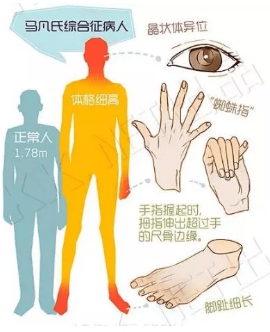 马凡氏综合症