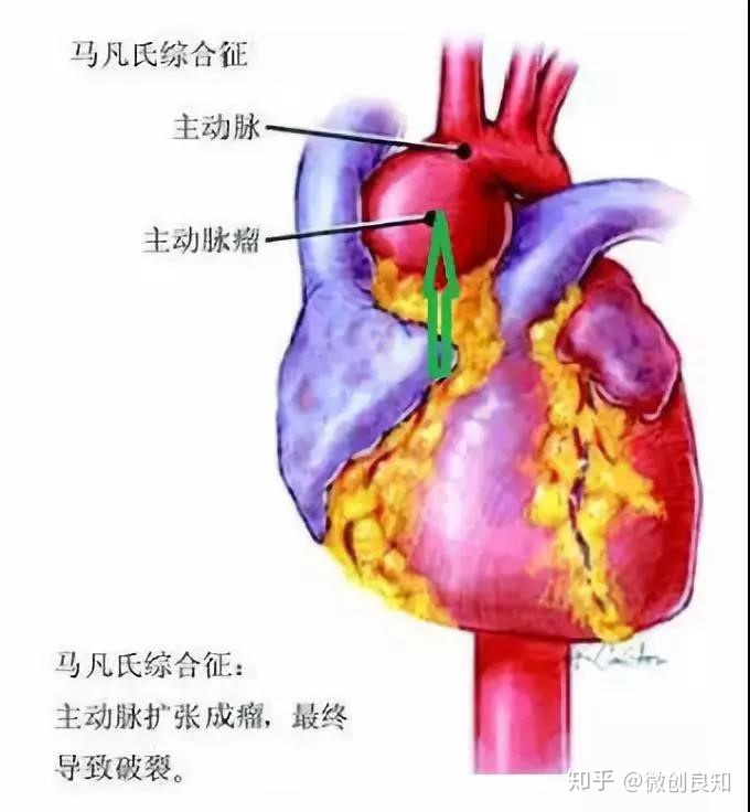 马凡氏综合症