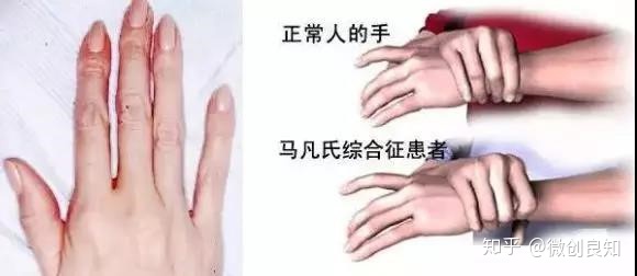 马凡氏综合症