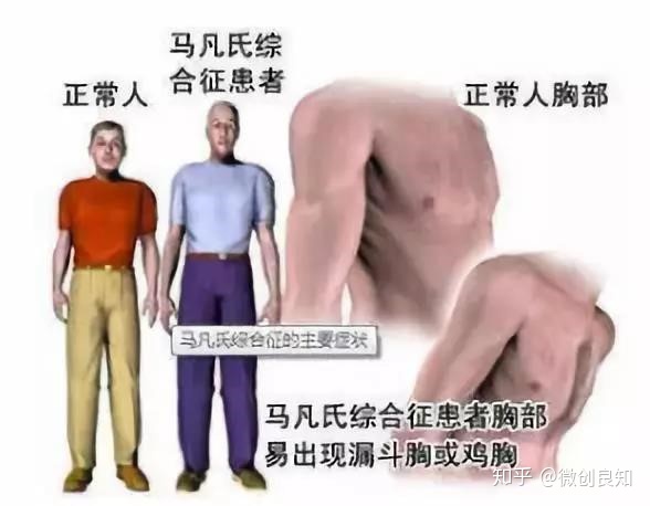 马凡氏综合症