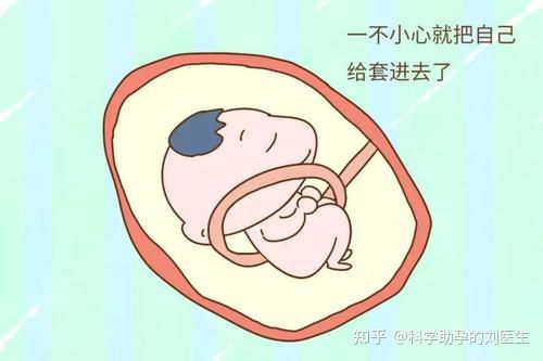 多胎妊娠减胎_妊娠足月胎停的原因_多胎妊娠