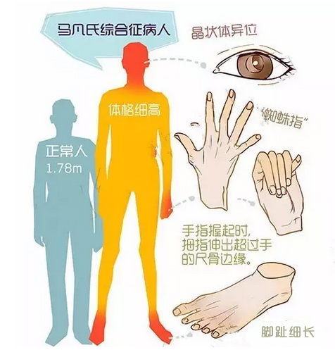 马凡氏综合症