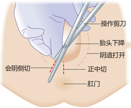 episiotomy_meitu_1.jpg