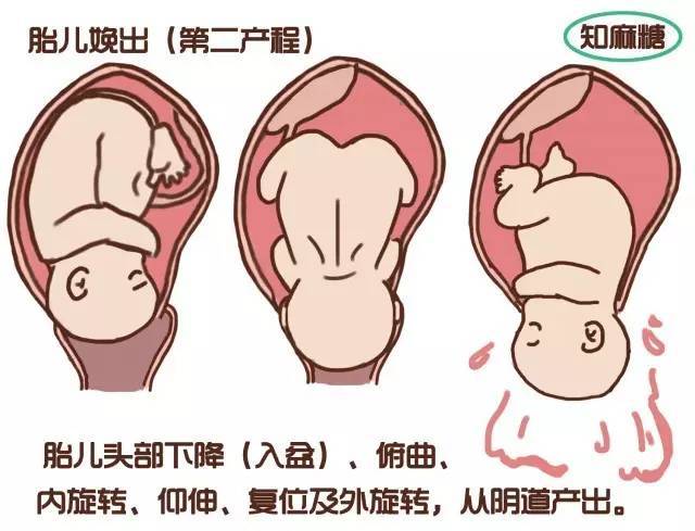 侧切_顺产侧切伤口_顺产侧切
