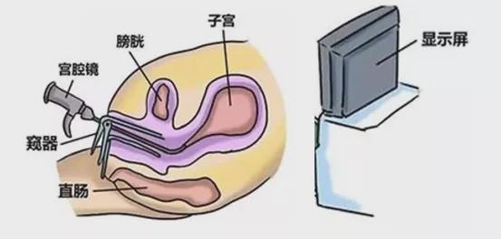 宫腔镜检查_宫腔镜检查?_什么情况做宫腔镜检查