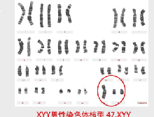 特纳氏综合症_特纳氏综合症男性_特纳氏综合症 病因