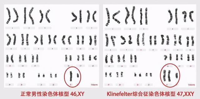 特纳氏综合症 病因_特纳氏综合症男性_特纳氏综合症