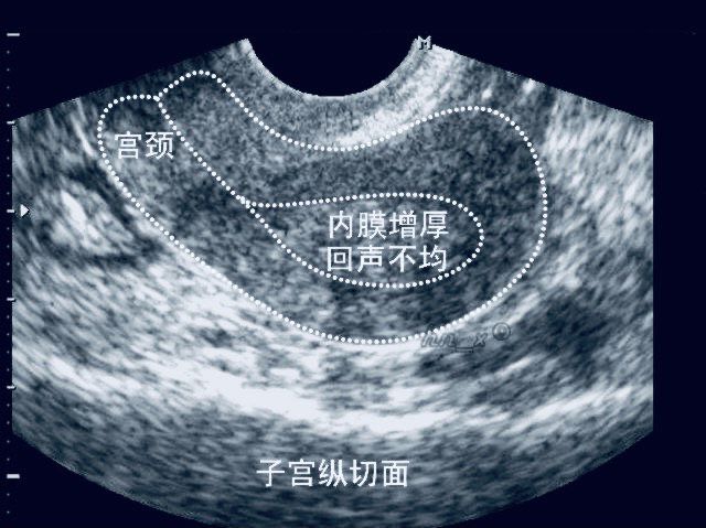 内膜厚度多少正常_正常子宫宫内膜厚度_子宫内膜厚度