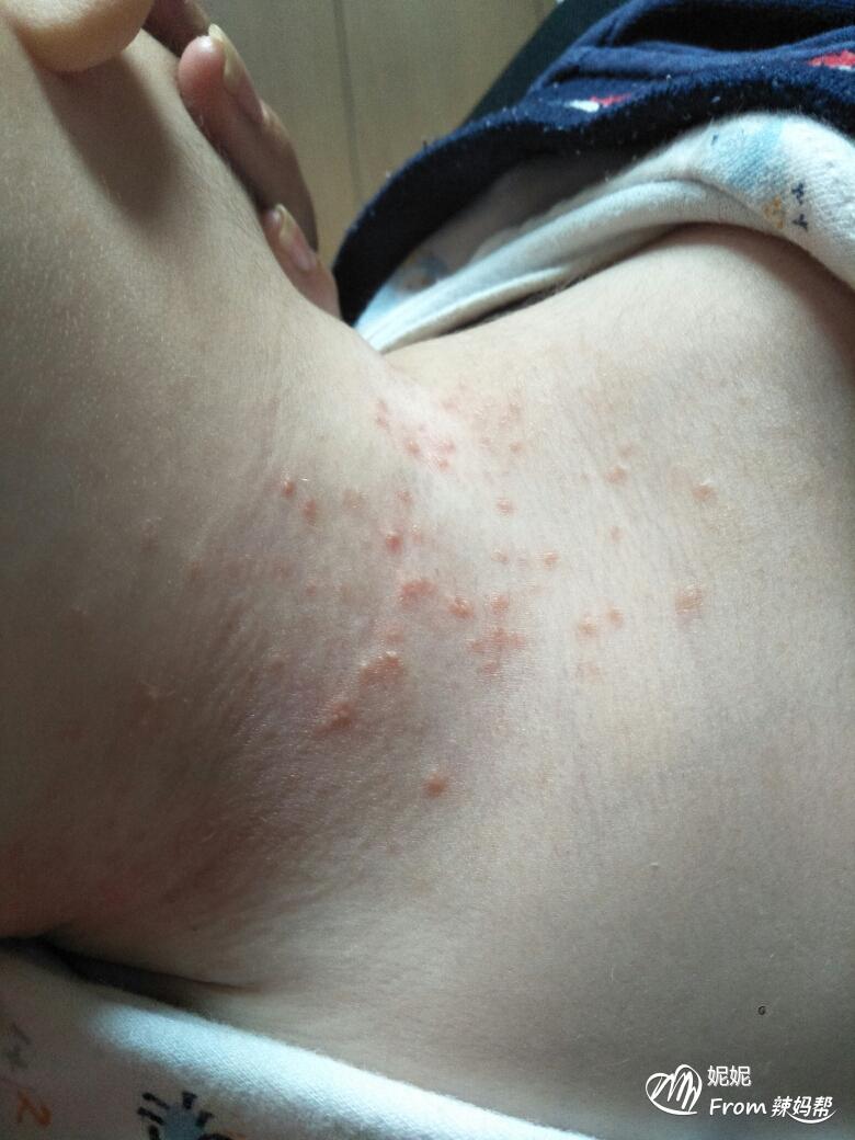 幼儿急疹_幼儿急疹_幼儿急疹的症状与治疗