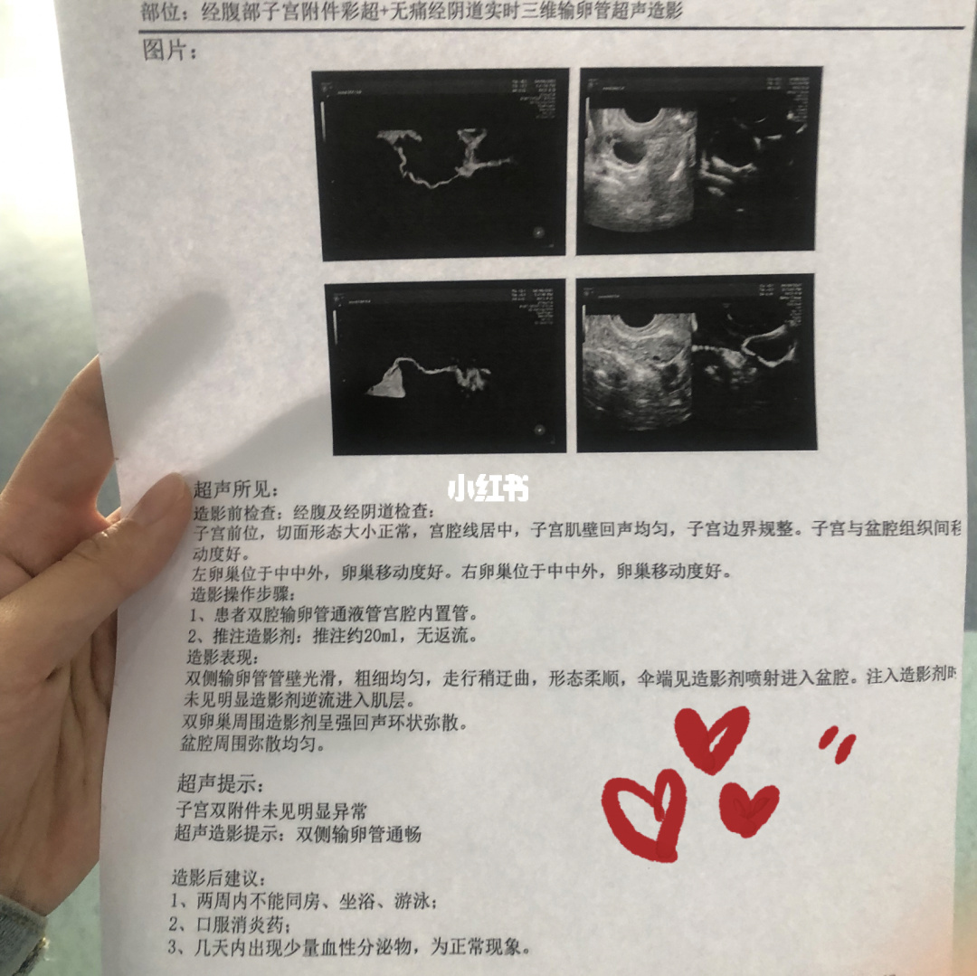 造影能疏通输卵管吗_输卵管造影_造影疏通输卵管吗