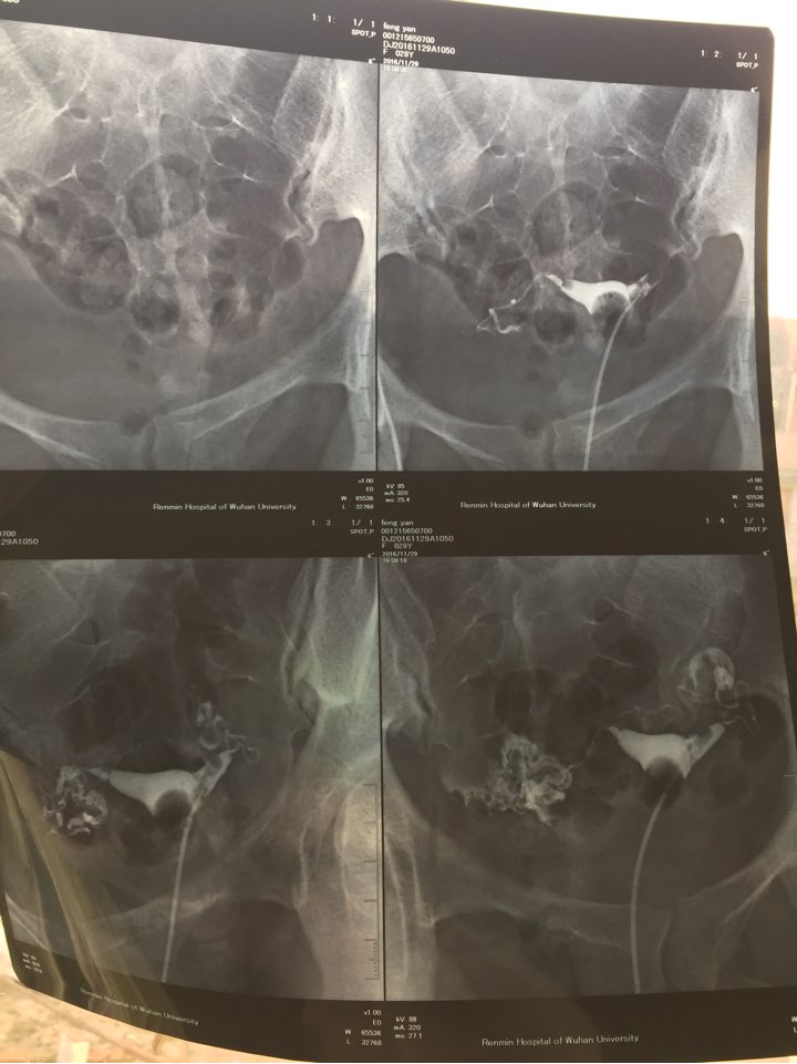 造影疏通输卵管吗_造影能疏通输卵管吗_输卵管造影