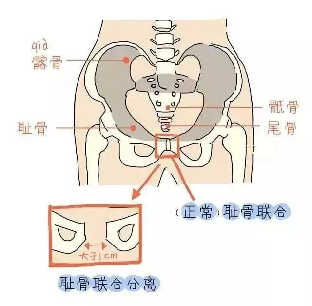 盆底肌修复