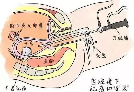 宫腔镜检查