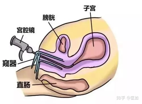 宫腔镜检查