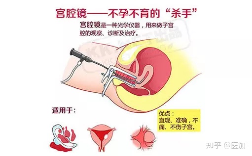 宫腔镜检查